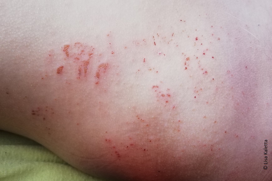 Eine Nahaufnahme von Lisas Haut mit Kratzspuren und roten Flecken. 